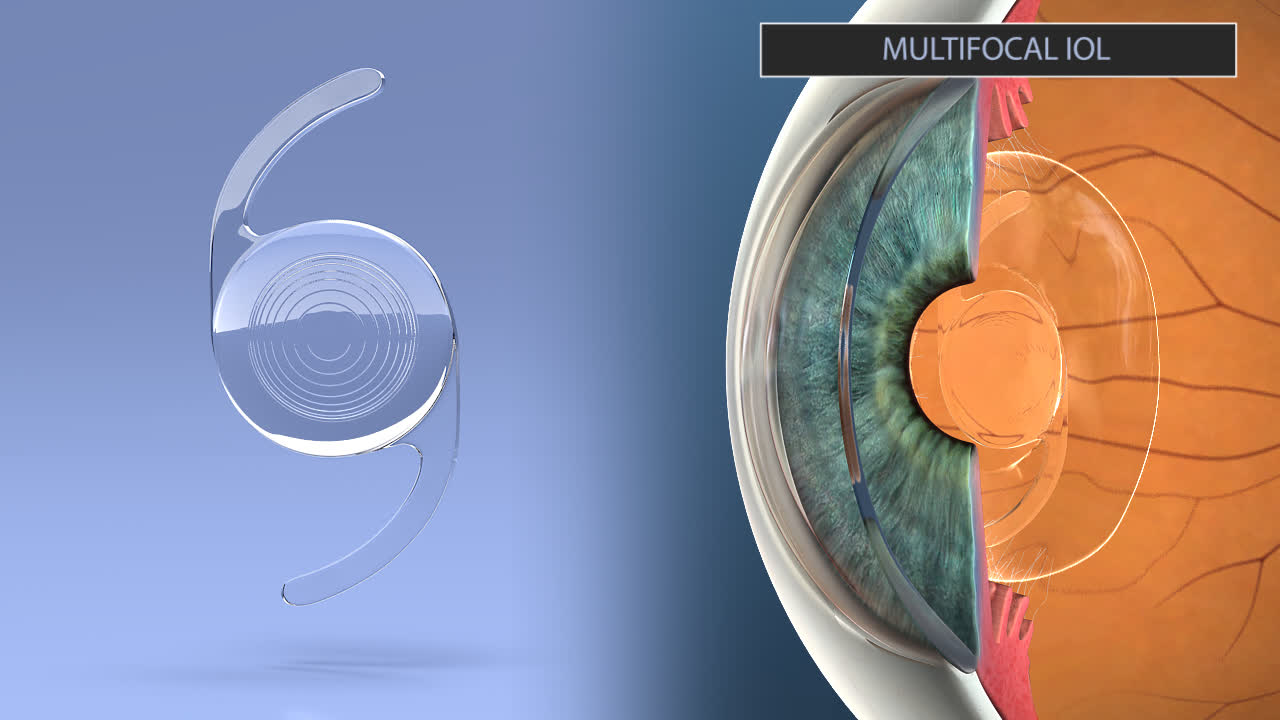 Advanced Technology Intraocular Lenses The Eye MDs
