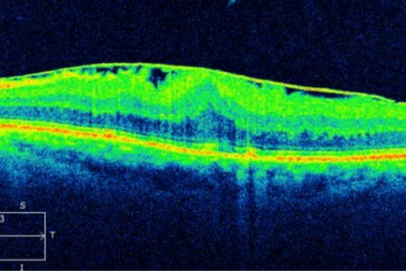 retsurg2 Epiretinal Membane (fine line on the top) causing the retina
to be thickened and pulled into folds.